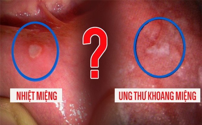 Chú ý 3 điểm sẽ tránh ung thư khoang miệng-1