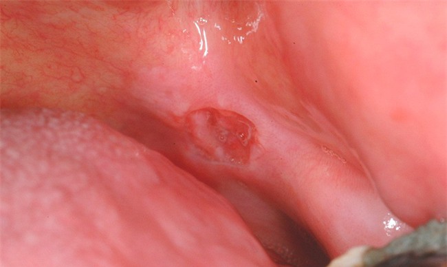 Chú ý 3 điểm sẽ tránh ung thư khoang miệng-2