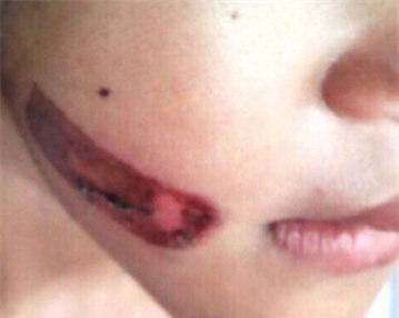 Vết bỏng trên mặt bé T. nghi bị cha ruột bạo hành. Ảnh do người thân bé T. cung cấp.