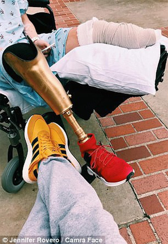 Sử dụng băng vệ sinh sai cách, người phụ nữ suýt nữa mất mạng, phải cắt bỏ cả 2 chân vì đau đớn - Ảnh 2.