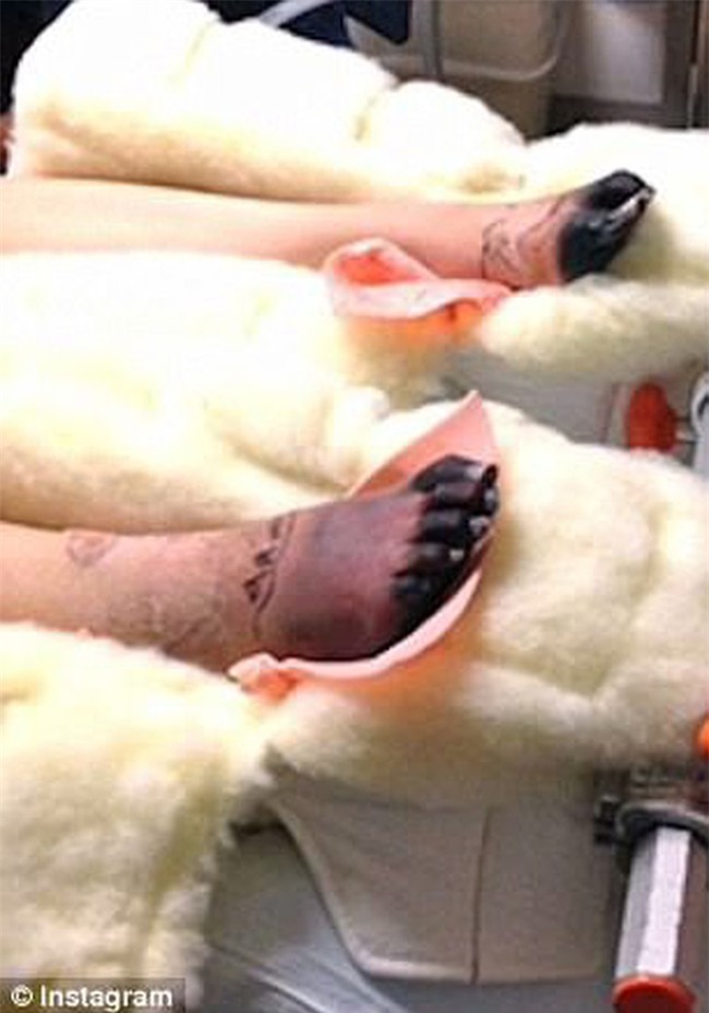 Sử dụng băng vệ sinh sai cách, người phụ nữ suýt nữa mất mạng, phải cắt bỏ cả 2 chân vì đau đớn - Ảnh 4.