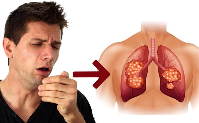 Ho như thế nào thì bạn nên đi khám để phòng ngừa bệnh ung thư phổi?-1