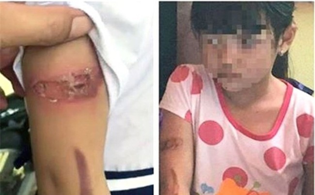 Bé gái bị bố đẻ mẹ kế bạo hành