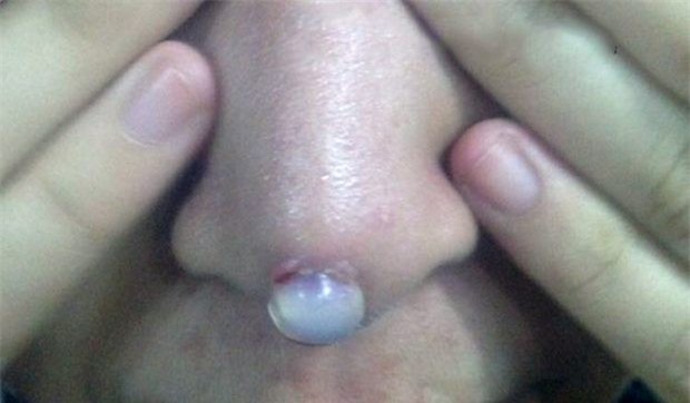 Thêm một cô gái đi phẫu thuật nâng mũi nhưng tham rẻ nên nhận hậu quả đau đớn, rách mũi để lộ cả silicon - Ảnh 2.