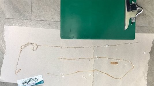 Thông tin mới về người đàn ông ăn sushi hàng ngày, mắc sán dây dài 1,67m - Ảnh 1.