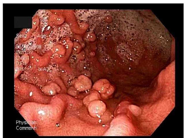 95% ca ung thư đại tràng liên quan đến nguyên nhân này-2