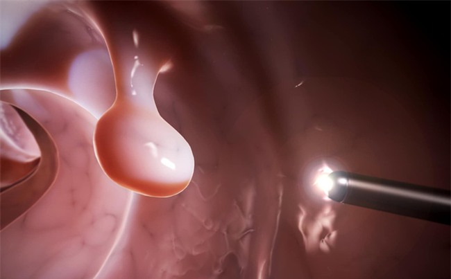 95% ca ung thư đại tràng liên quan đến nguyên nhân này-3