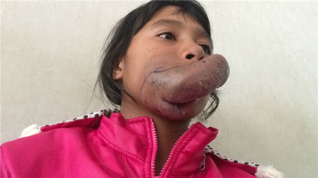 khối u,u máu,bệnh viện Chợ Rẫy,hiếm gặp,bệnh hiếm