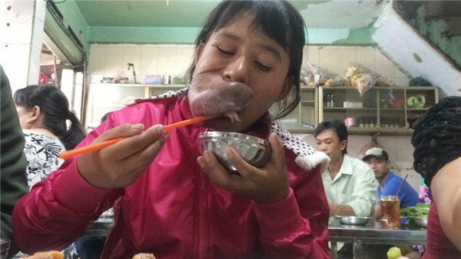 khối u,u máu,bệnh viện Chợ Rẫy,hiếm gặp,bệnh hiếm