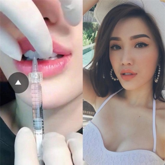 Lộ ảnh được cho là Bảo Thy đi tiêm môi căng mọng, khác hẳn ngoại hình trong quá khứ - Ảnh 1.