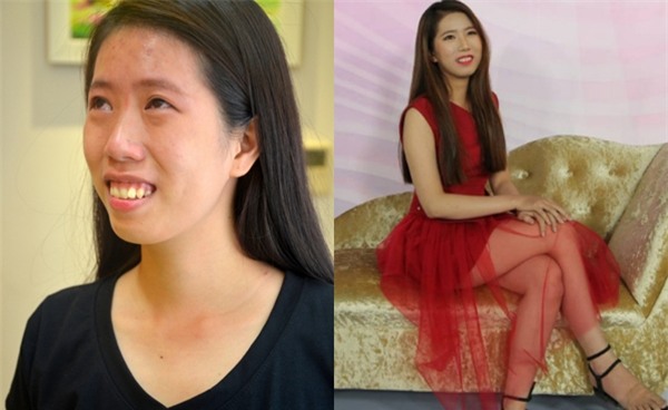 Trở về từ ca phẫu thuật hàm hô, cô gái trẻ khiến người thân không nhận ra-1