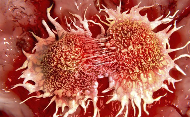 Không ăn thịt đỏ cũng có thể bị ung thư trực tràng: Hãy cảnh giác với những lý do này-2