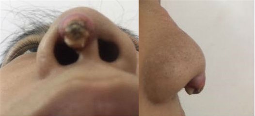 biến chứng làm đẹp, biến chứng, phẫu thuật thẩm mỹ, Sài Gòn,