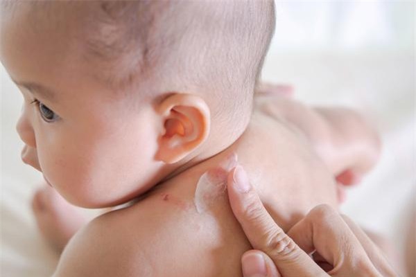 be bi noi man do khap nguoi nhung khong sot can dieu tri the nao? - 4