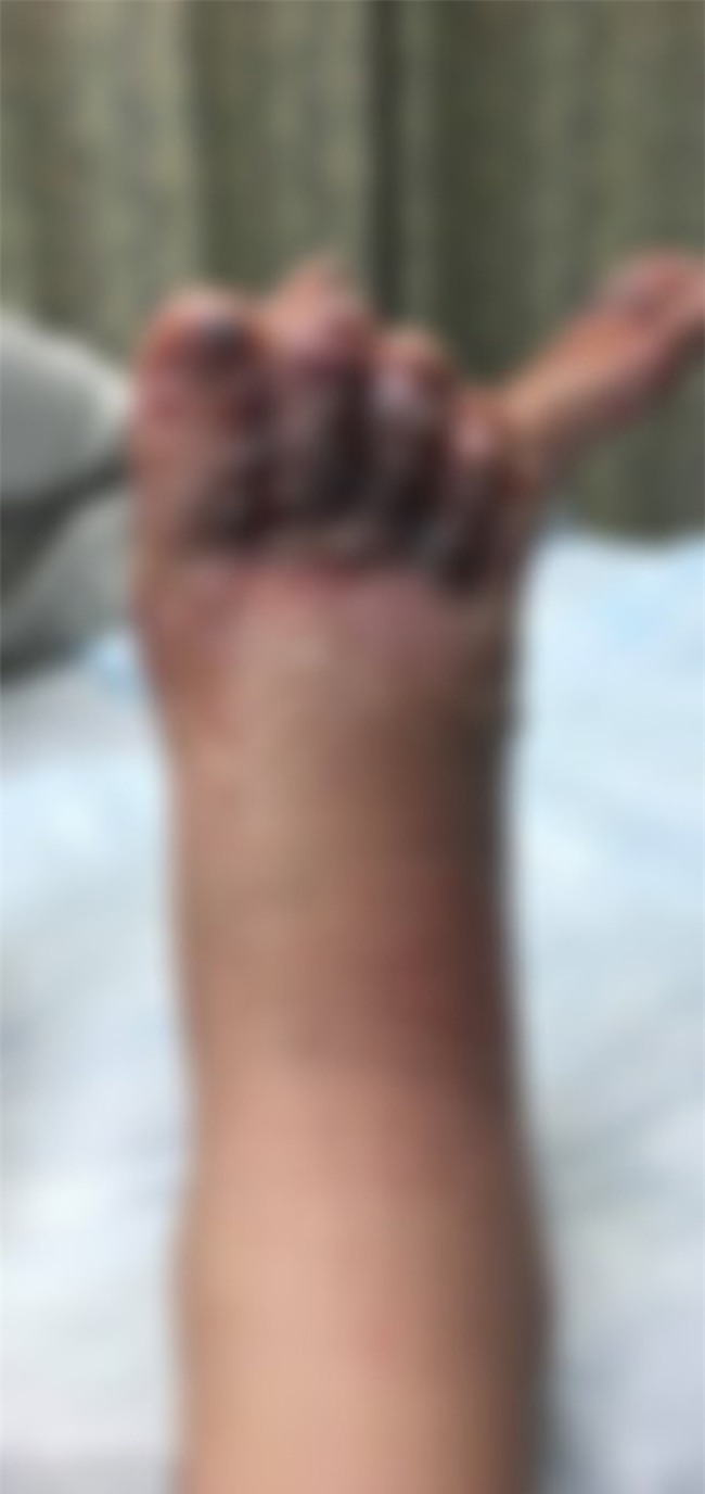 Đi chân trần trên biển, cặp vợ chồng kinh hãi khi thấy đôi chân sưng phồng, chuyển màu đen tím - Ảnh 2.