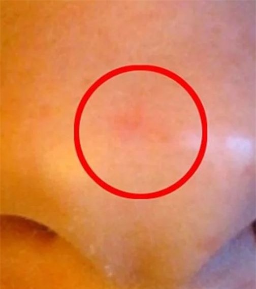 KHIẾP SỢ: Mũi thủng lỗ khổng lồ chỉ vì dùng thuốc mỡ sai cách-1