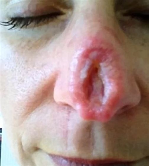 KHIẾP SỢ: Mũi thủng lỗ khổng lồ chỉ vì dùng thuốc mỡ sai cách-3