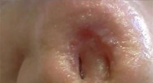 KHIẾP SỢ: Mũi thủng lỗ khổng lồ chỉ vì dùng thuốc mỡ sai cách-4