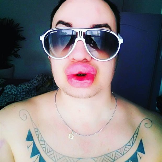 Nghiện phẫu thuật thẩm mỹ, anh chàng bơm môi căng phồng tới hơn 20 lần để nhìn giống... Marilyn Monroe - Ảnh 4.