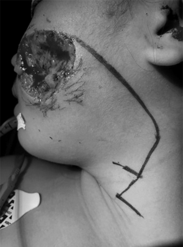 Chơi đùa với chó, bé gái 8 tuổi bị cắn biến dạng mặt - Ảnh 1.