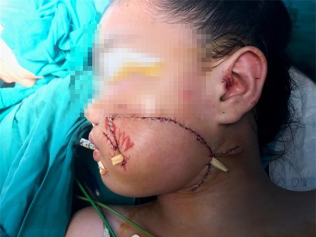 Chơi đùa với chó, bé gái 8 tuổi bị cắn biến dạng mặt - Ảnh 2.