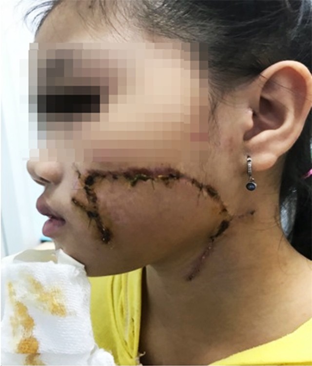 Chơi đùa với chó, bé gái 8 tuổi bị cắn biến dạng mặt - Ảnh 3.