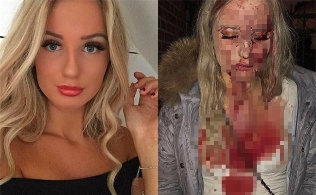 Không cho gã bợm rượu sờ soạng, cô gái xinh đẹp bị hủy hoại dung nhan ngay giữa hộp đêm - Ảnh 1.