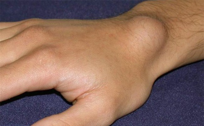 Khi xuất hiện 4 dấu hiệu này hãy coi chừng trong cơ thể bạn đã có tế bào ung thư