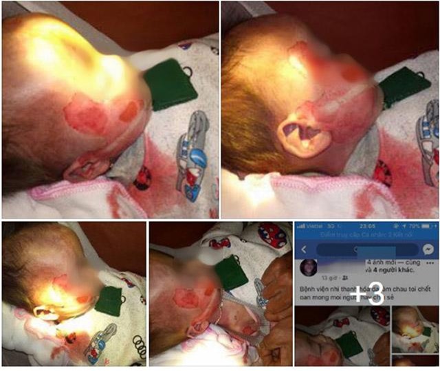 vu be trai 15 thang tuoi tu vong voi nhieu vet thuong la: benh vien nhi thanh hoa len tieng - 1