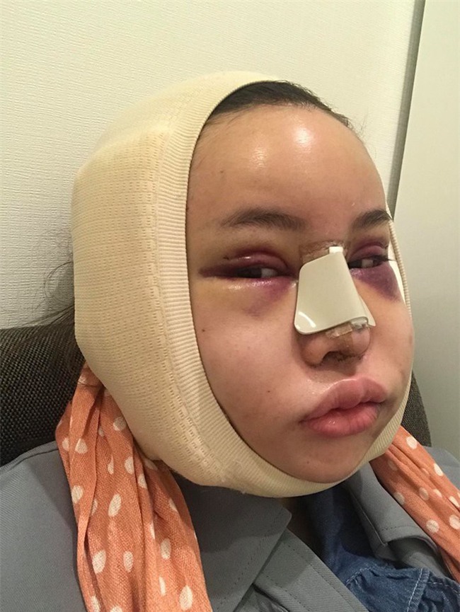 Hot Facebooker Thái Lan "bật mí" quá trình phẫu thuật thẩm mỹ đau đớn nhưng trả về kết quả đẹp xuất sắc - Ảnh 2.