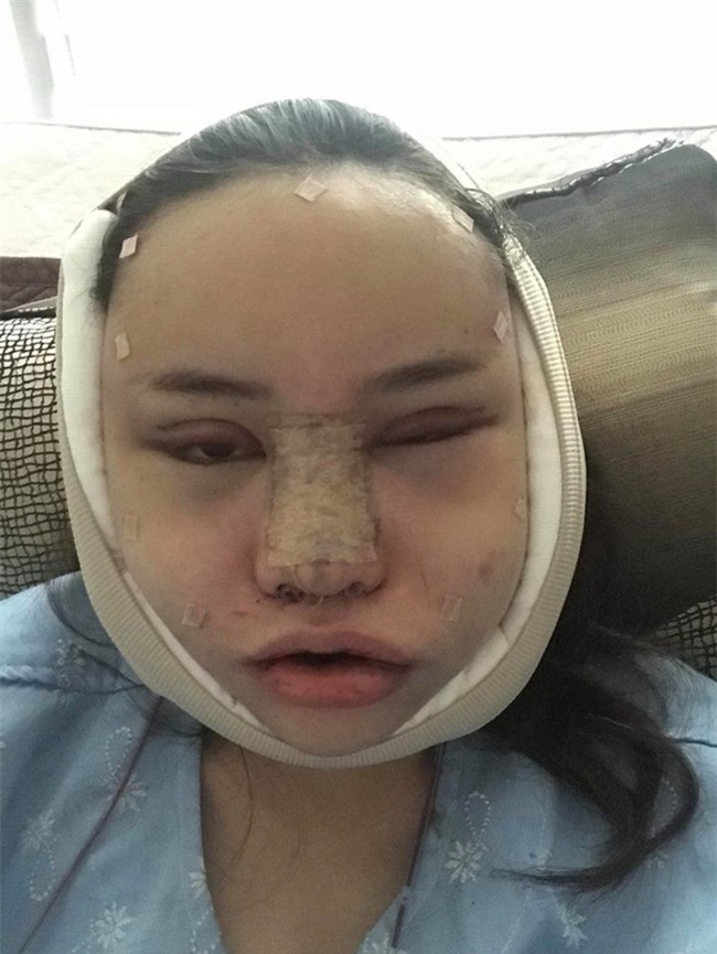 Hot Facebooker Thái Lan "bật mí" quá trình phẫu thuật thẩm mỹ đau đớn nhưng trả về kết quả đẹp xuất sắc - Ảnh 2.