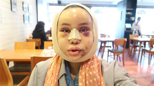 Hot Facebooker Thái Lan "bật mí" quá trình phẫu thuật thẩm mỹ đau đớn nhưng trả về kết quả đẹp xuất sắc - Ảnh 2.