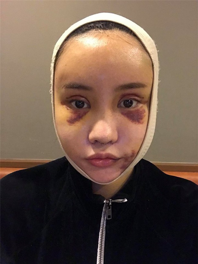 Hot Facebooker Thái Lan bật mí quá trình phẫu thuật thẩm mỹ đau đớn nhưng trả về kết quả đẹp xuất sắc - Ảnh 3.