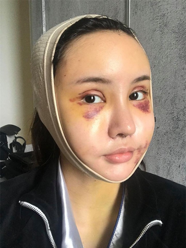 Hot Facebooker Thái Lan "bật mí" quá trình phẫu thuật thẩm mỹ đau đớn nhưng trả về kết quả đẹp xuất sắc - Ảnh 4.