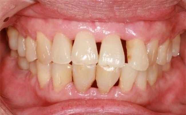 Có thể bị ung thư phổi, ung thư đại tràng vì vệ sinh răng miệng kém-1