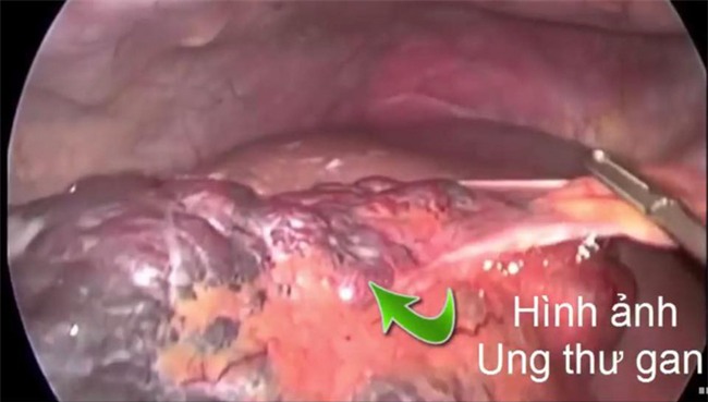 Chuyên gia BV Ung bướu chỉ rõ 4 nhóm người dễ mắc ung thư gan nhất: Biết sớm để đề phòng-2