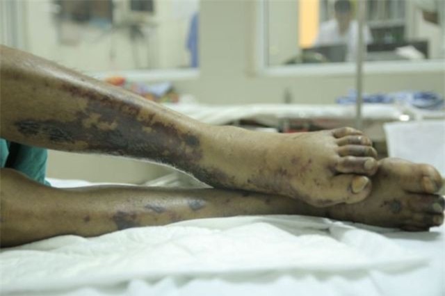 Ăn tiết canh chưa thấy may mắn đã mất Tết vì nhập viện cấp cứu-3