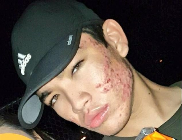 Trong 8 tháng, chàng trai đã chữa khỏi tình trạng da mụn nghiêm trọng bằng những sản phẩm bình dân giá chỉ khoảng 400 ngàn - Ảnh 3.