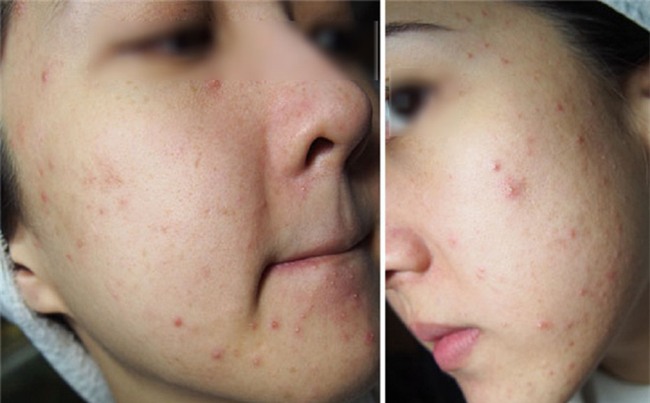 Nếu thử loạt sản phẩm mà vẫn chưa khỏi mụn, các nàng hãy thử dùng baking soda xem sao! - Ảnh 2.