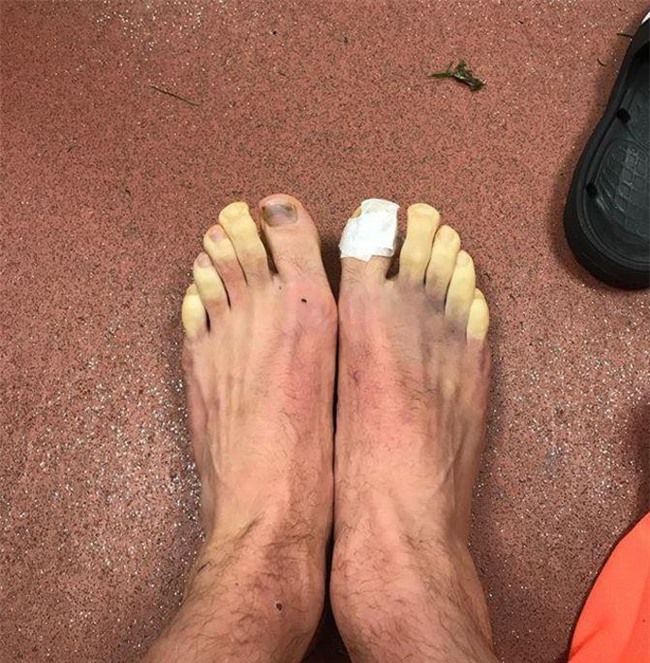 Sao Ngoại hạng Anh khoe đôi bàn chân biến dạng kinh dị - Ảnh 2.