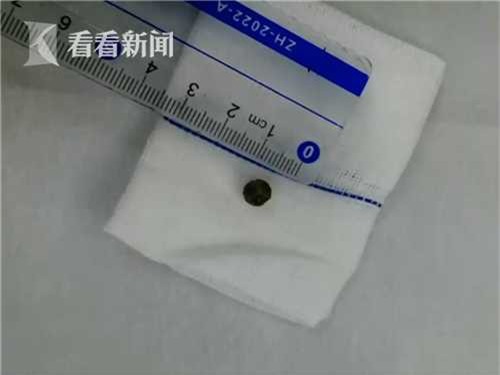 Con ho, sốt liên tục suốt nửa năm trời, mẹ không ngờ nguyên nhân lại chỉ vì hạt trân châu trong cốc trà sữa - Ảnh 2.