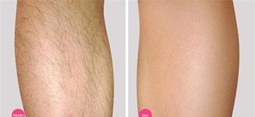 tuong tan cac buoc triet long vinh vien tai nha voi oxy gia ai ai cung lam duoc! - 4