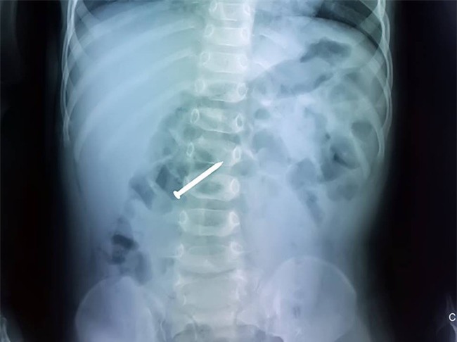 Chưa kịp ăn Tết, bé trai 2 tuổi đã suýt chết vì nuốt phải cây đinh rớt ra trong đồ chơi - Ảnh 1.