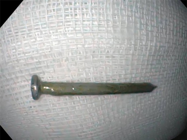 Chưa kịp ăn Tết, bé trai 2 tuổi đã suýt chết vì nuốt phải cây đinh rớt ra trong đồ chơi - Ảnh 2.