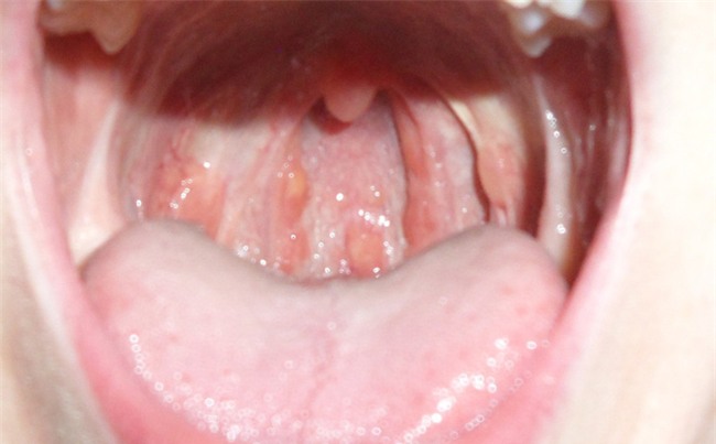 Cần đề phòng ung thư trước những vết loét họng này-1