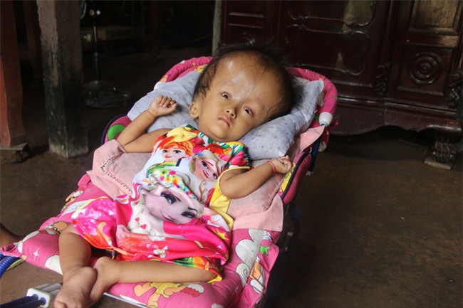 Phép màu kỳ diệu đến với cặp vợ chồng trẻ nuôi con gái 4 tuổi bị não úng thủy, đầu to gấp 3 lần trong năm mới - Ảnh 3.