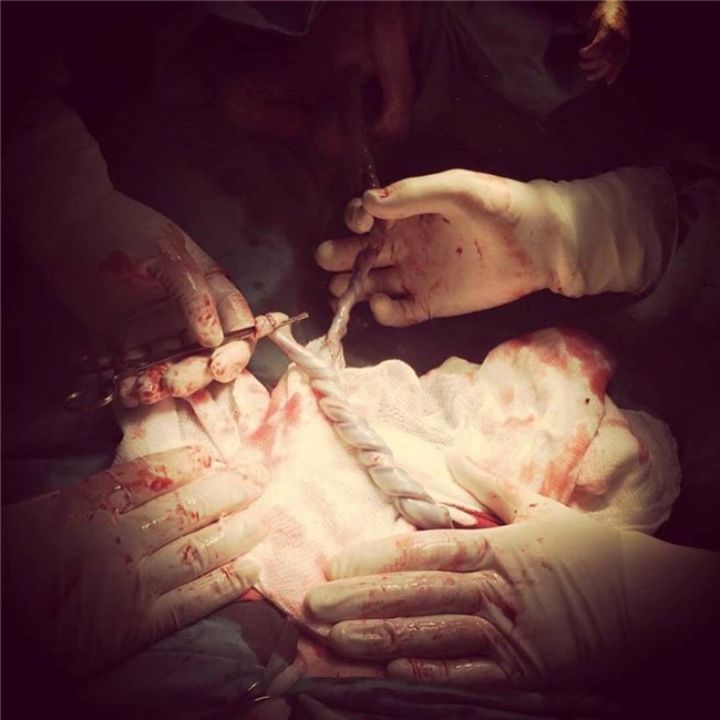 Hi hữu ca sinh đôi có 2 dây rốn xoắn như tết tóc - Ảnh 1.