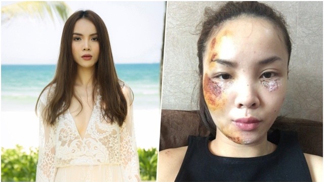 Không chỉ Harry Lu, nhiều Sao Việt cũng từng gặp tai nạn nguy hiểm đến tính mạng-7