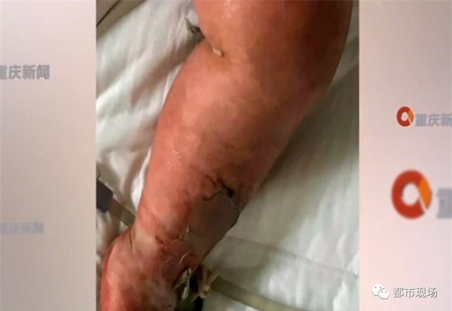 Thấy em sợ tiếng pháo, anh họ bế vào nhà không may vấp phải bình nước sôi, khiến em toàn thân bỏng nặng - Ảnh 2.