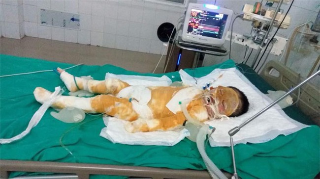 Thái Bình: Chập điện cháy nhà giữa đêm, vợ chồng bỏng nặng, bé gái 4 tuổi nguy kịch